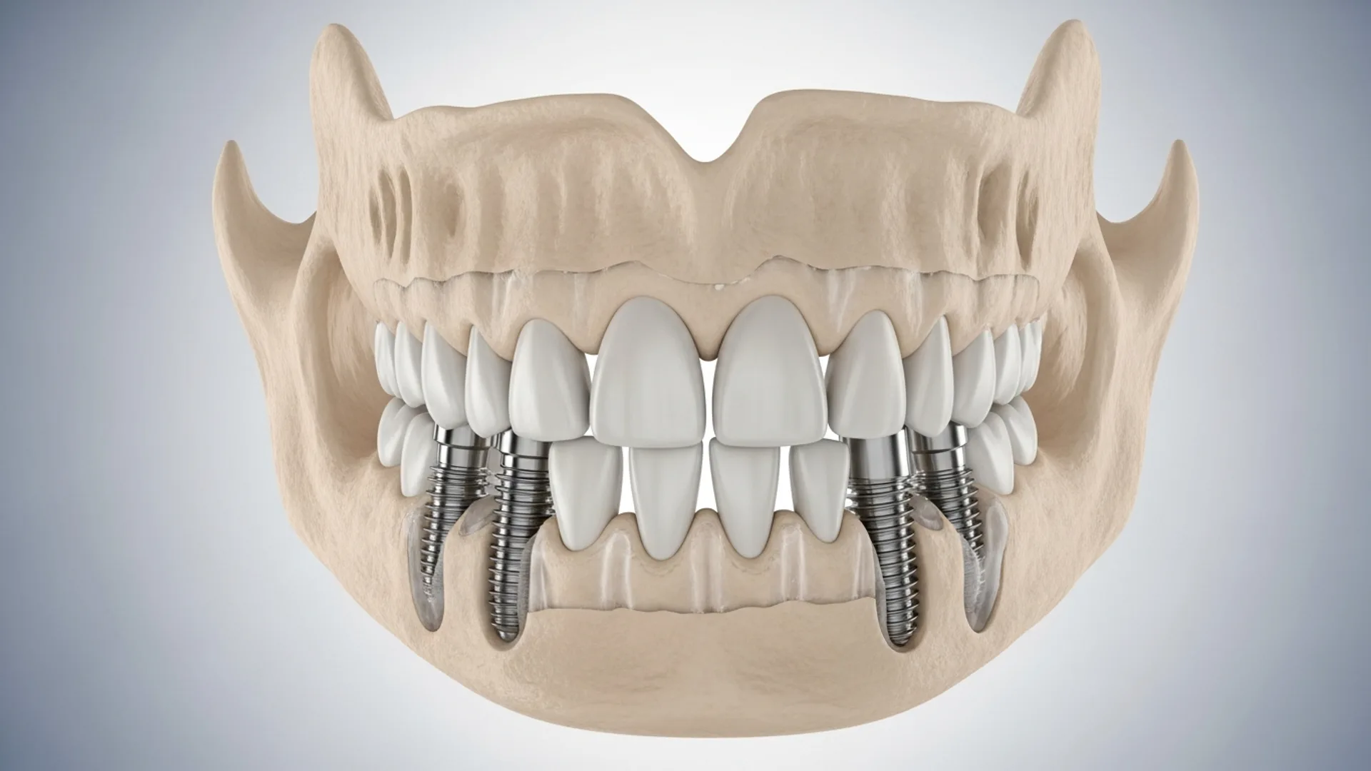 Anatomical 3D illustration of four titanium implants placed in a lower jaw, two anterior implants vertical and two posterior implants angled.