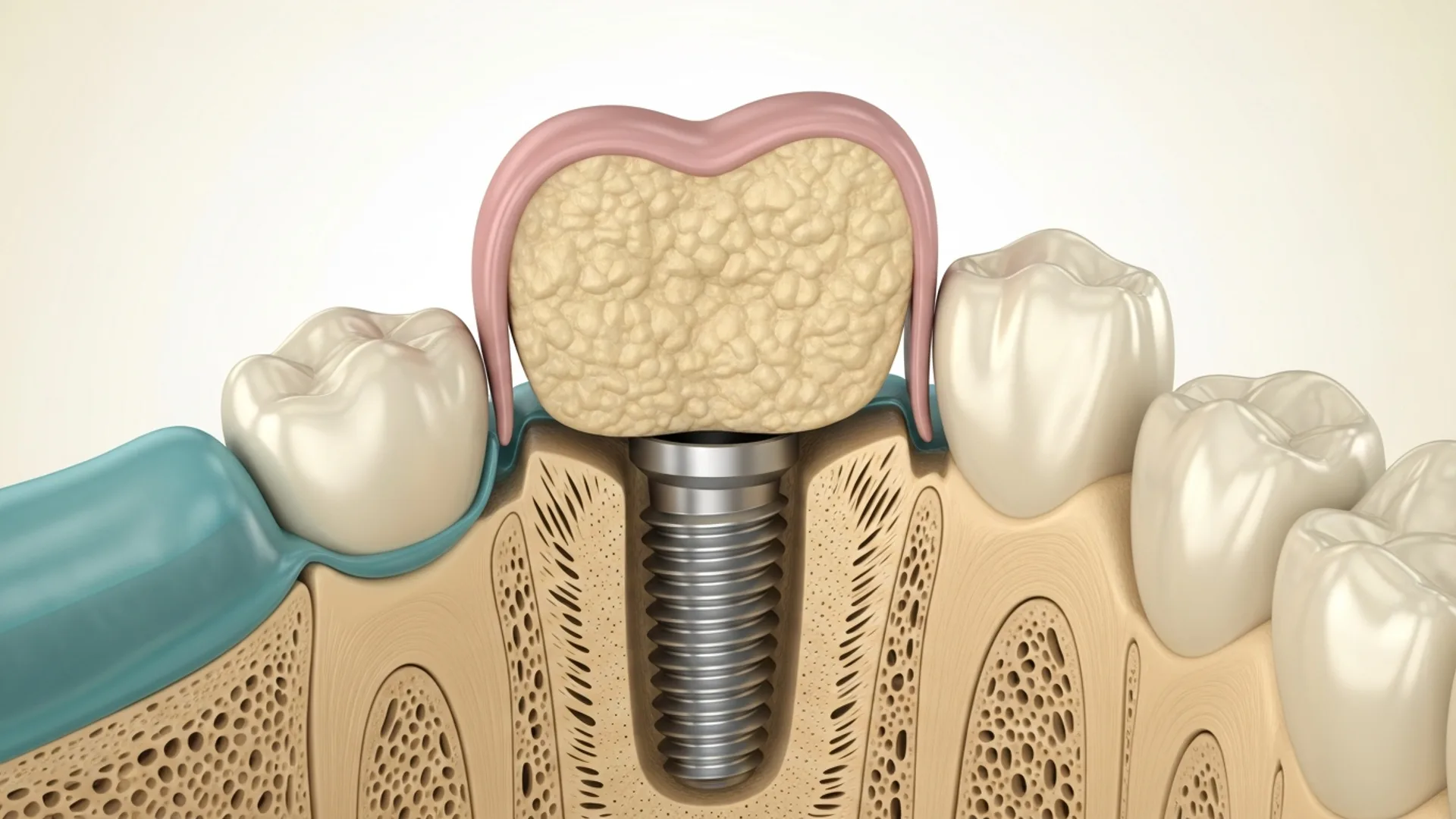 Cross-section illustration of a titanium implant fully osseointegrated and ready to support a final bridge.
