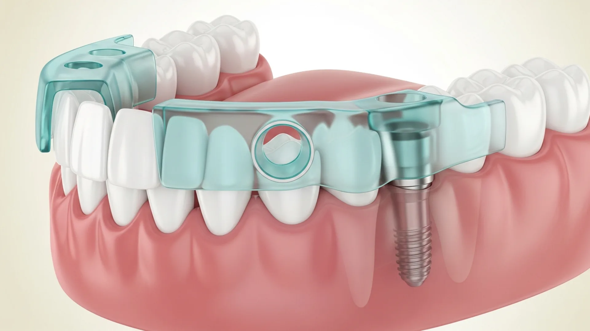 3D illustration of a translucent custom surgical guide seated over the lower posterior gum, ready for implant placement.