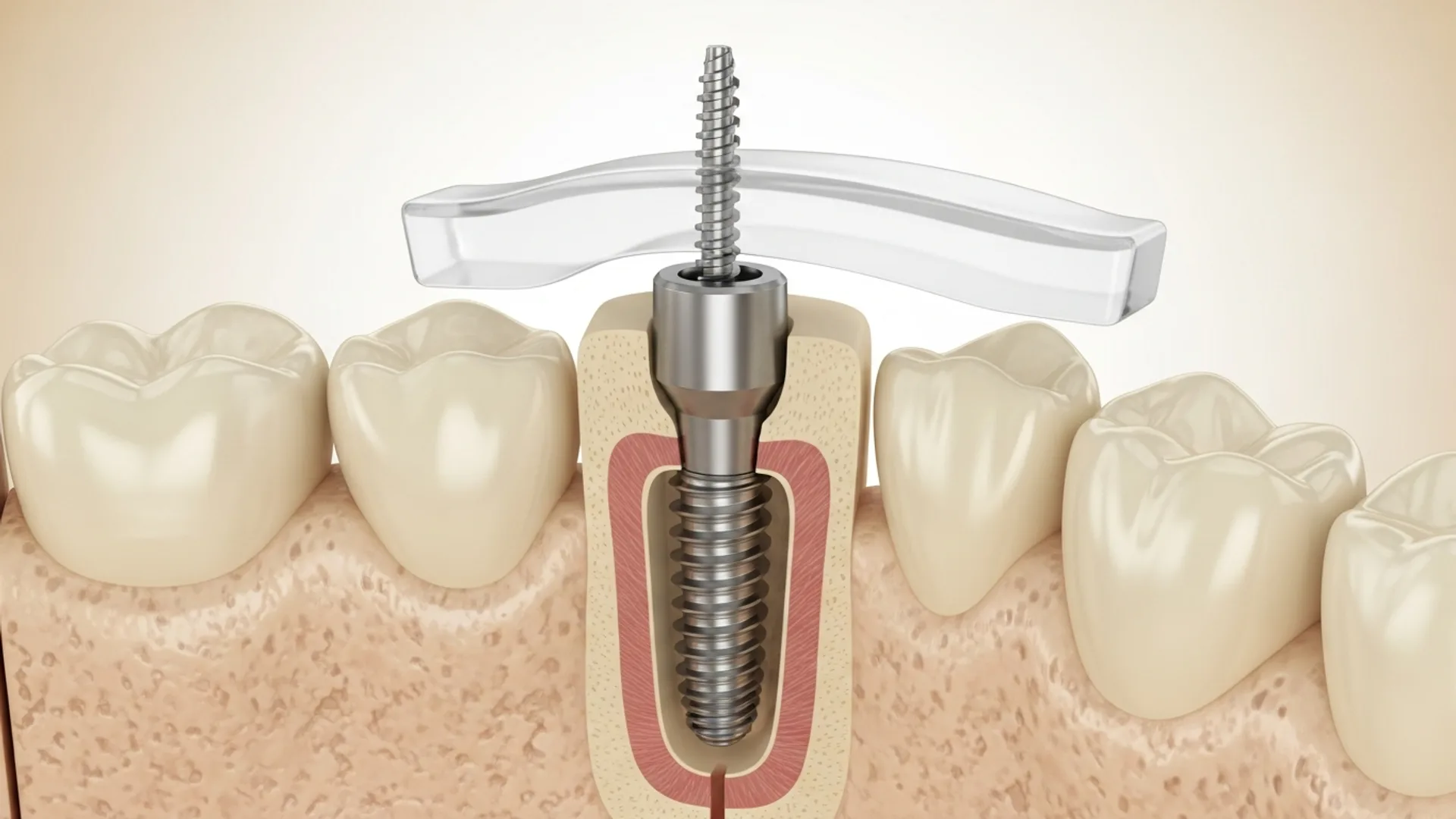 3D cross-section illustration of a titanium implant being precisely threaded into the lower jawbone through the surgical guide.