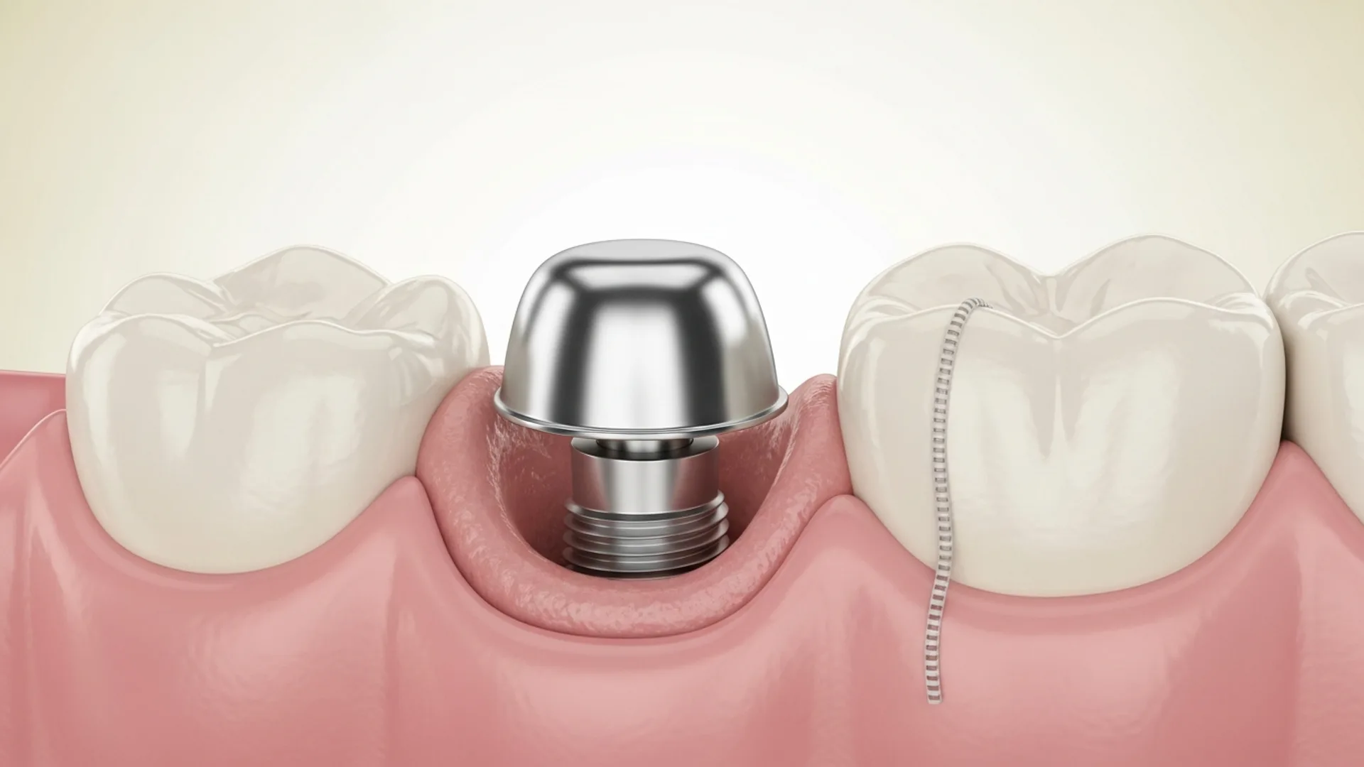 Close-up illustration of a small titanium healing cap on top of a single implant in healthy gum tissue with one neat suture.