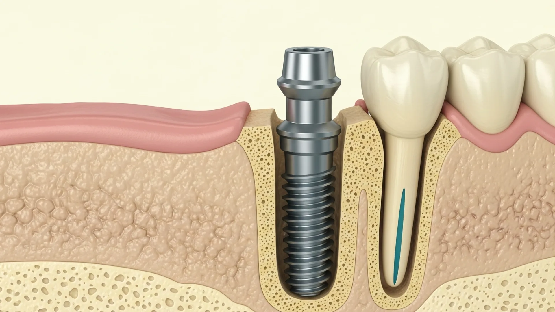 Cross-section illustration of a fully osseointegrated single implant ready to receive an abutment and crown.